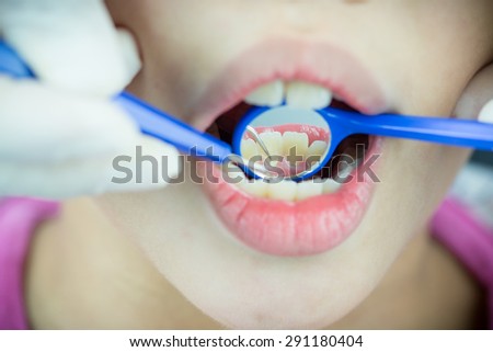 close-up medical dentist procedure of teeth polishing with cleaning calculus, focus on mirror