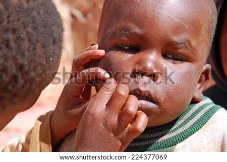 August 2014-Village of Pomerini - Tanzania- Africa-African unidentified children of the Franciscan Mission of Pomerini for humanitarian aid against AIDS while cleaning your face from dirt and scabs of the disease.