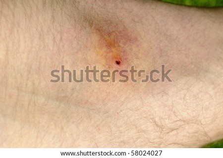 infected tick bite on thigh
