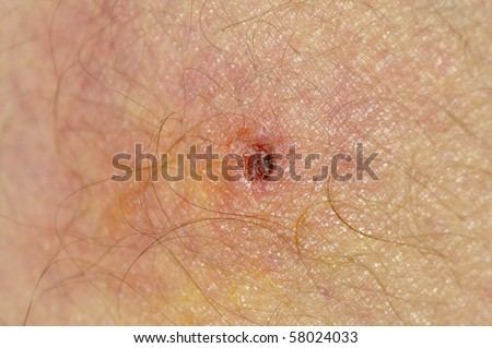 What do Tick Bites Look Like – Tick Bite Pictures