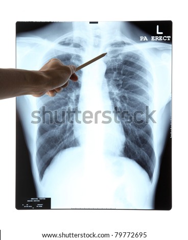 Hand pointing the chest x-ray