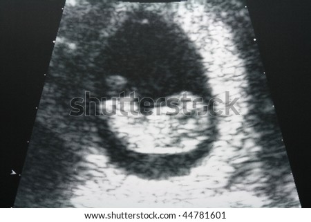 ultrasound image of a human embryo and gestation sac at 10 week pregnancy