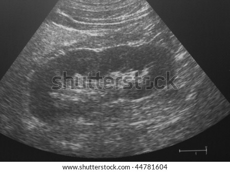 ultrasound image of a human normal kidney