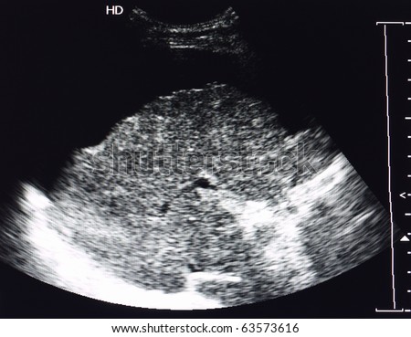 stock photo : ultrasound image of liver cirrhosis and ascites