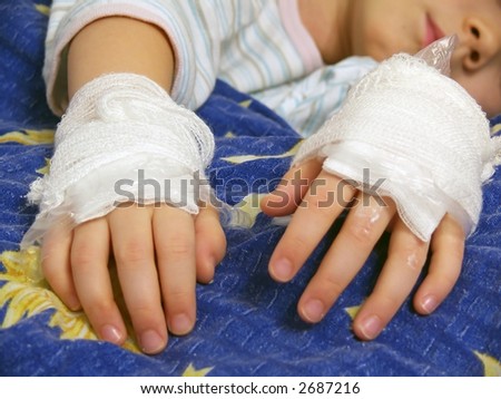 Young Girl Illness, Bandage, Foil, Ointment On The Hands, Burns And Scalds 