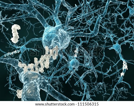 Alzheimer\'s disease - neurons with amyloid plaques
