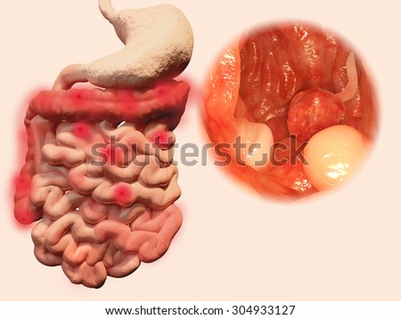Polyps in the gastrointestinal tract