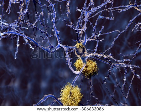 Alzheimer disease: neuron with amyloid plaques,