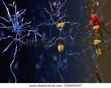 3 phases of the Alzheimer disease.\
1. Healthy neuron. 2. Neuron with amyloid plaques (yellow). 3. Dead neuron being digested by microglia cells (red)