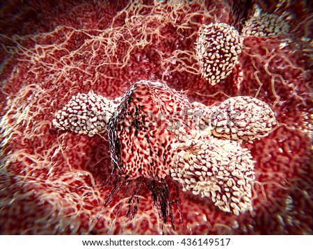 T lymphocytes attacking cancer cell; 3D-rendering\
Natural killer cells are a type of lymphocytes which destroy cancer cells and other altered cells releasing cytotoxic granules.