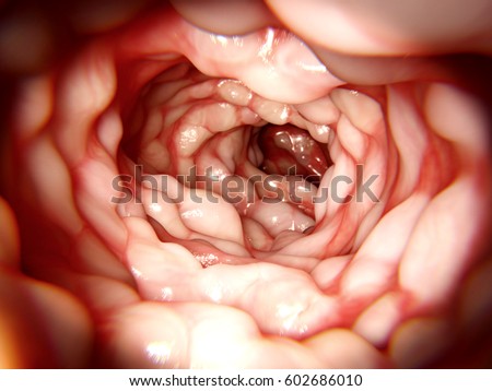 Intestine affected by Morbus Crohn. 3d rendering.\
Crohn\'s disease is an inflammatory bowel disease, it causes abdominal pain, diarrhea and vomiting.