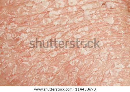 Psoriasis vulgaris is an autoimmune disease that affects the skin, detail photography for mainly medical magazines