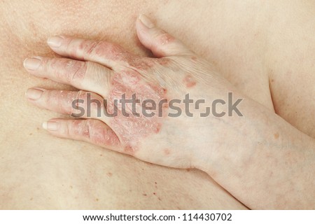 Psoriasis vulgaris is an autoimmune disease that affects the skin, detail photography for mainly medical magazines