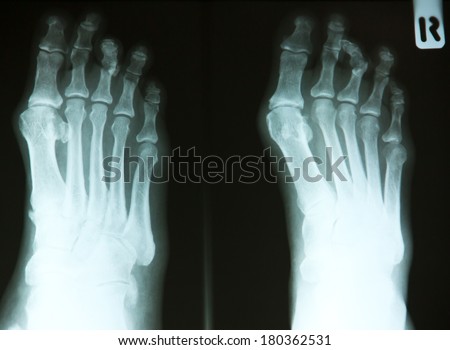 Foot x-ray.