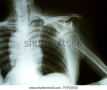 Bone, shoulder dislocation