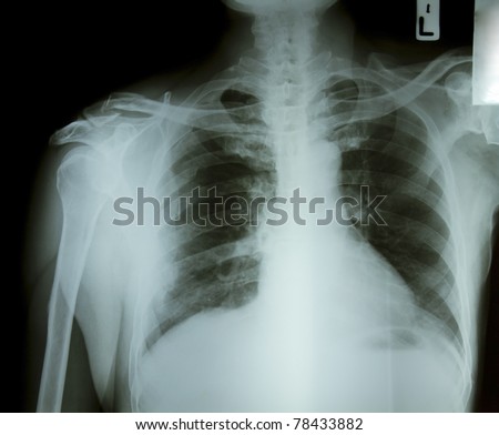 X-ray rib fracture