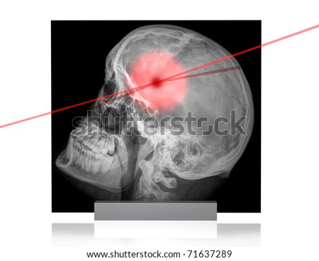 illustration of skull x-ray with pain point