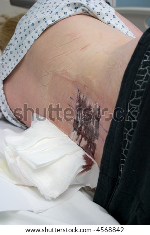Patient on her side after back surgery in hospital bed about to be dressed