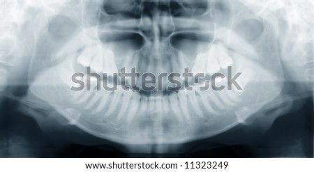 An x-ray of a human jaw, with problematic wisdom teeth