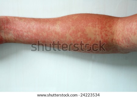 Typical macular rash in the forearm. This could represent viral (dengue) rash.