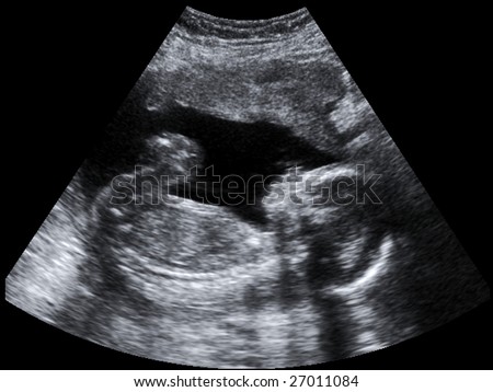 Baby Sonogram Pictures on Ultrasound Baby Stock Photo 27011084   Shutterstock