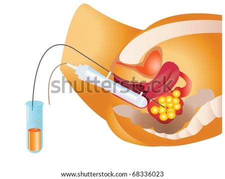 Ivf Sperm