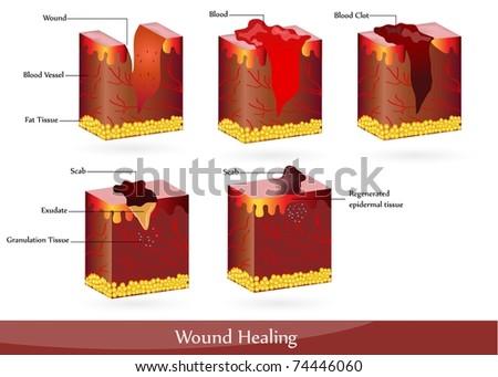 The Process Of Wound Healing. Illustration Showing Skin After Injury 