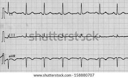 Electrocardiography (aka EKG Elektrokardiogramm) to measure heartbeat