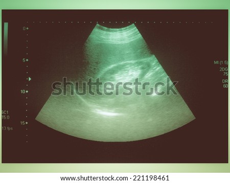 Vintage looking Ultrasound scan medical imaging of abdomen diagnosing gallstones