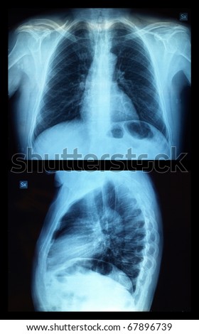 Medical X ray imaging of human bones