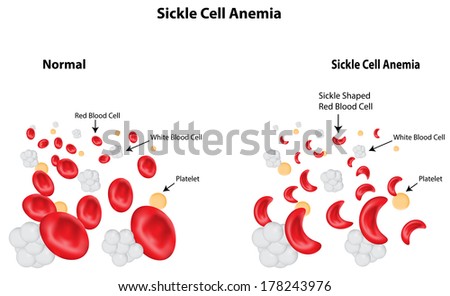 Sickle Cell Anemia Sickle Cell Anemia