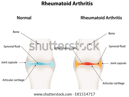 Rheumatoid Arthritis Synovial Joint