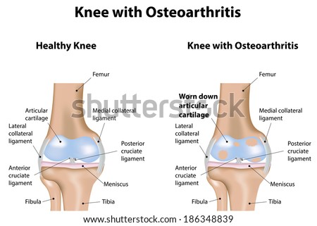 Knee Joint with Osteoarthritis Arthritis Diagram Knee Joint with Osteoarthritis Arthritis Diagram