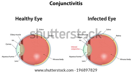 Conjunctivitis Conjunctivitis