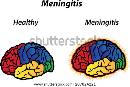 Meningitis Meningitis