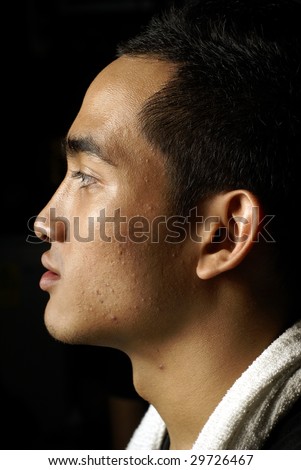 Asian man side profile with dark background, pimples and acne on face