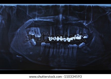Dental x-ray showing a missing tooth, root canal, and fillings in molars and bicuspids