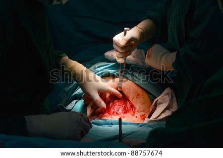 New baby being born during cesarean section