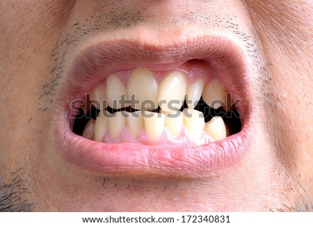 Close up of really crooked teeth