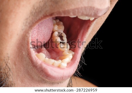 Dental Filling, Tooth Filling, Cavity Filling, Silver Filling