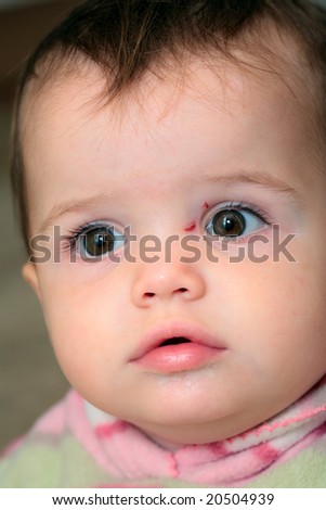 Pretty, young baby girl with scratches around her eyes from growing fingernails