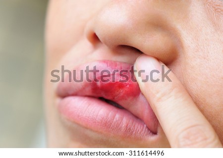 people show upper lip of the mouth with injury