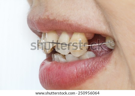 Close-up mouth of crooked teeth with braces.