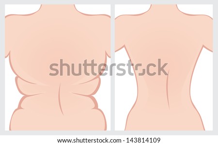 Fat back before and after treatment Fat back before and after treatment
