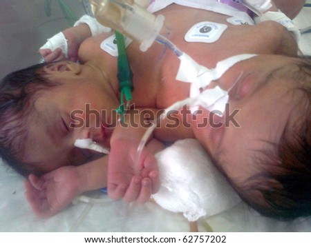 KARACHI, PAKISTAN - OCT 08: Conjoined twins, who came from Larkana, are being treated at surgical unit at National Institute for Child Health (NICH) on October 08, 2010 in Karachi, Pakistan