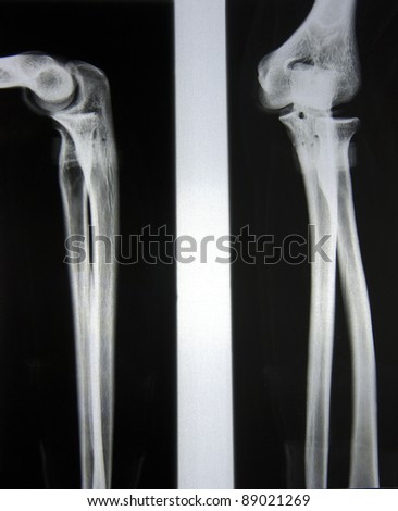 x-Ray picture of forearm and elbow from to angles