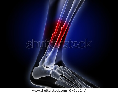 Lower Leg Fracture