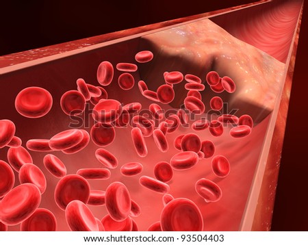 Artery Clot