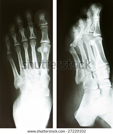 two x-ray of a human foot, heath and medical research