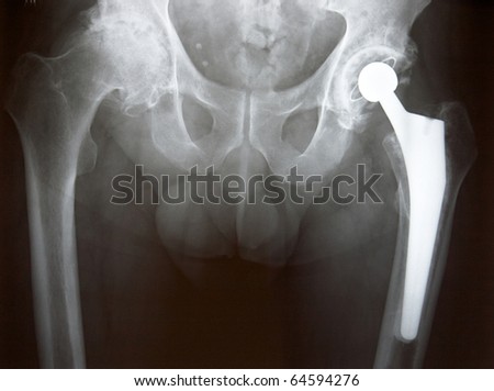 Xray of Left  Hip Replacement